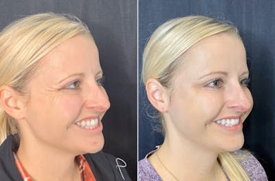 BOTOX Before & After Gallery - Patient 8525148 - Image 2