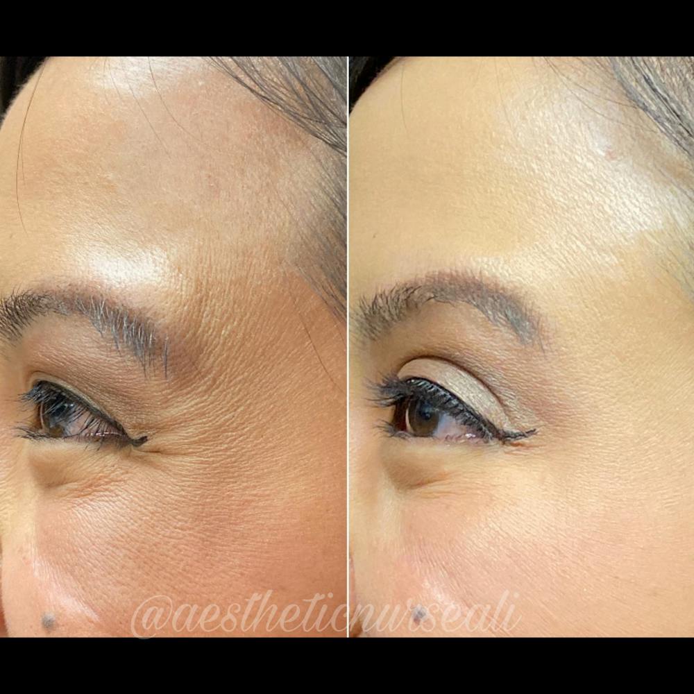 BOTOX Before & After Gallery - Patient 8525150 - Image 2