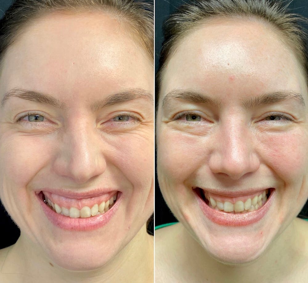 BOTOX Before & After Gallery - Patient 8525151 - Image 1