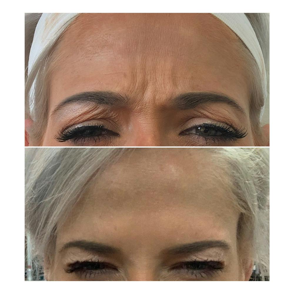 BOTOX Before & After Gallery - Patient 8525152 - Image 1
