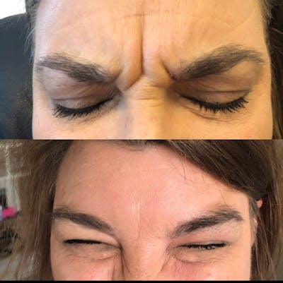 BOTOX Before & After Gallery - Patient 8525153 - Image 1