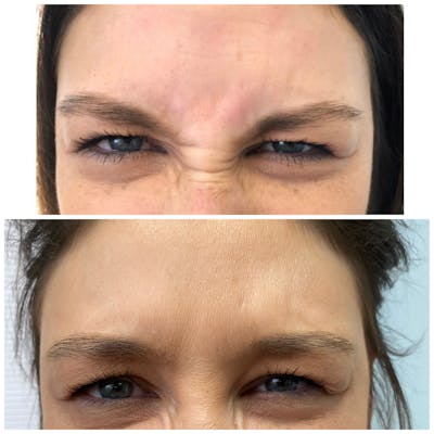 BOTOX Before & After Gallery - Patient 8525155 - Image 1