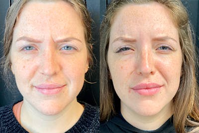 BOTOX Before & After Gallery - Patient 8525156 - Image 1