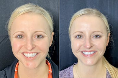 BOTOX Before & After Gallery - Patient 8525162 - Image 1