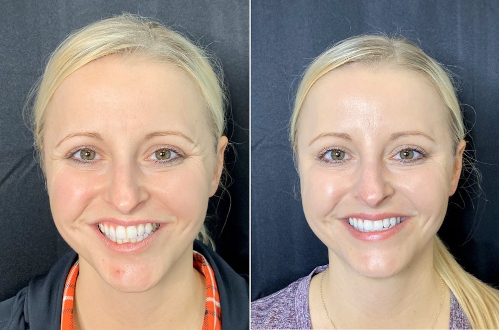 BOTOX Before & After Gallery - Patient 8525162 - Image 1