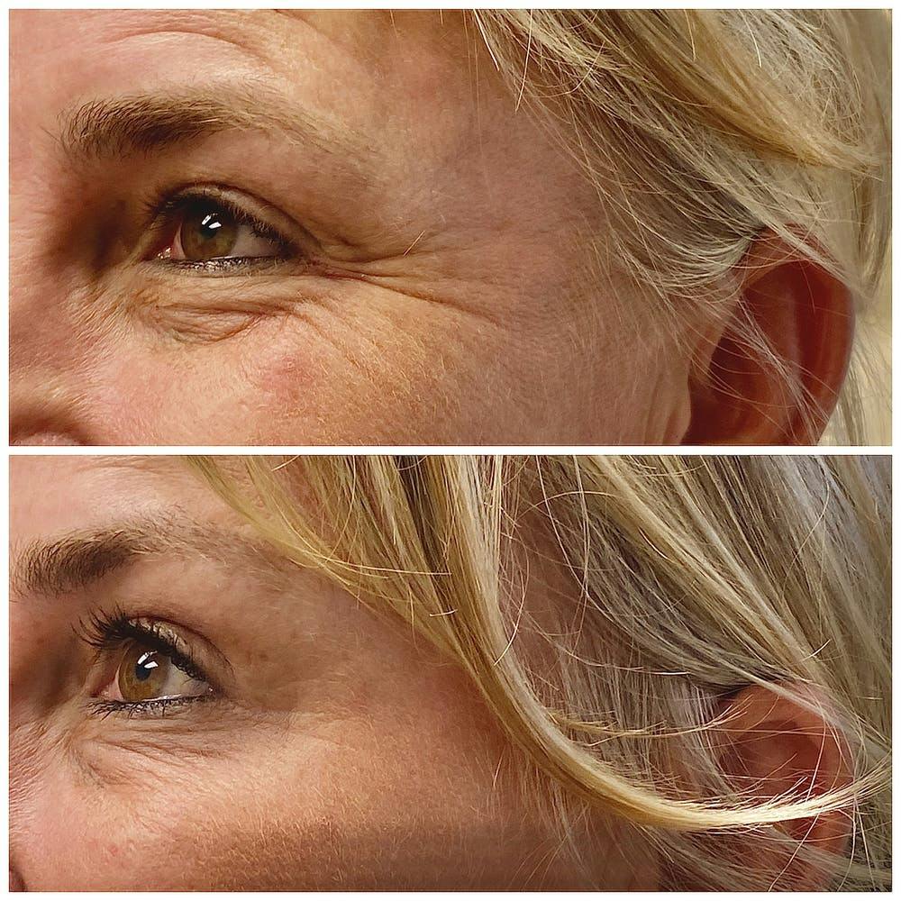 BOTOX Before & After Gallery - Patient 8525163 - Image 1