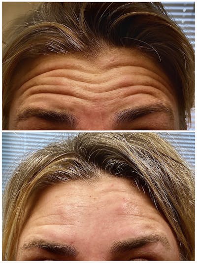 BOTOX Before & After Gallery - Patient 8525164 - Image 1