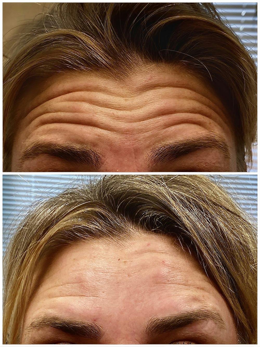 BOTOX Before & After Gallery - Patient 8525164 - Image 1