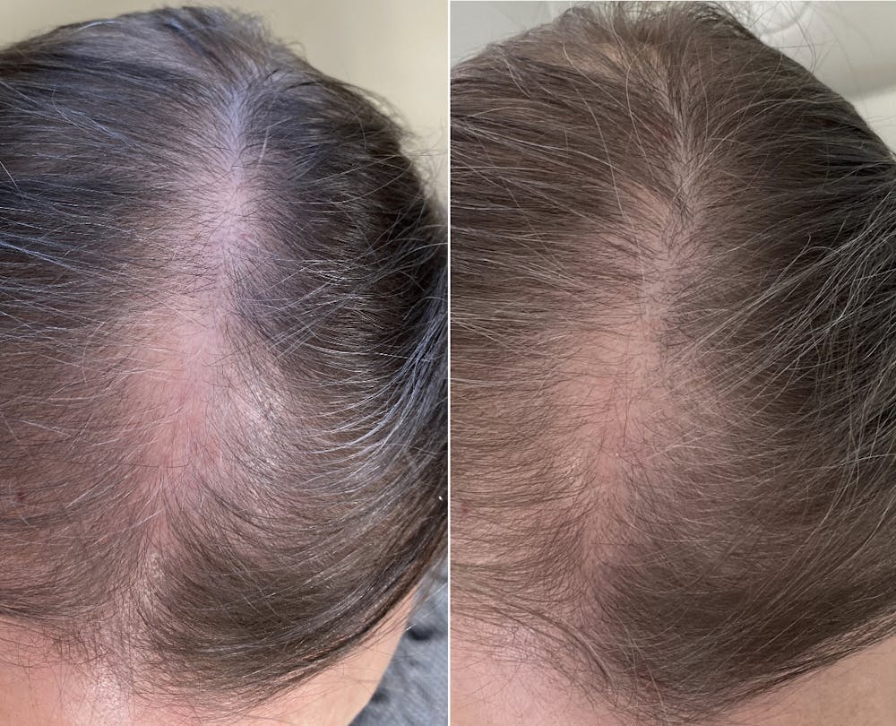 Hair Restoration  Before & After Gallery - Patient 144658919 - Image 1