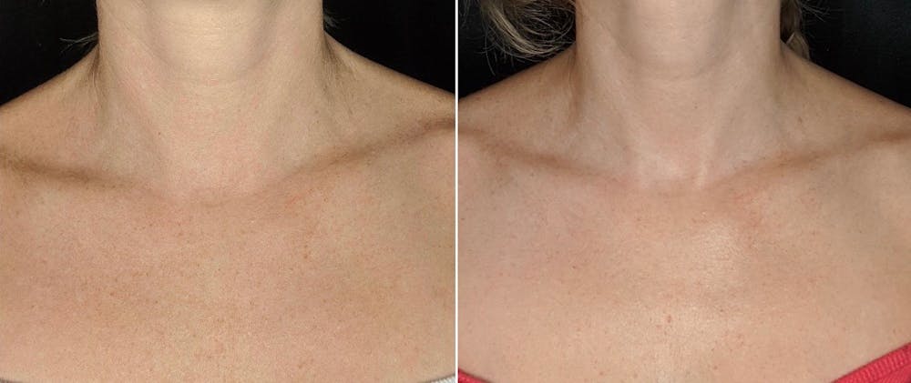 BBL Hero Before & After Gallery - Patient 8561158 - Image 3