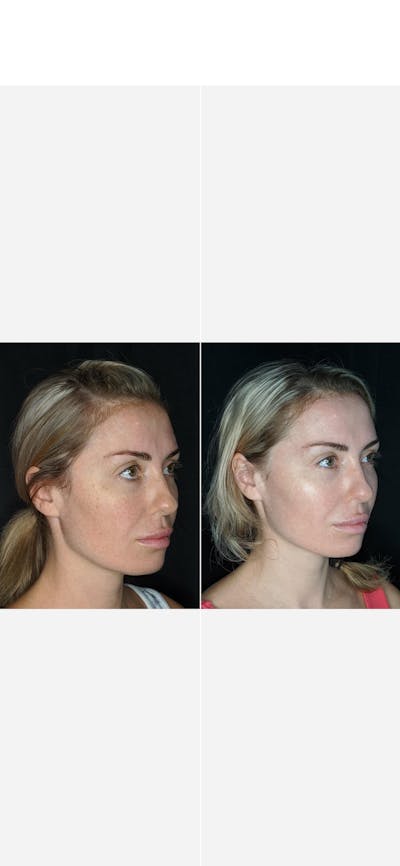 Sciton Halo Before & After Gallery - Patient 8561165 - Image 2