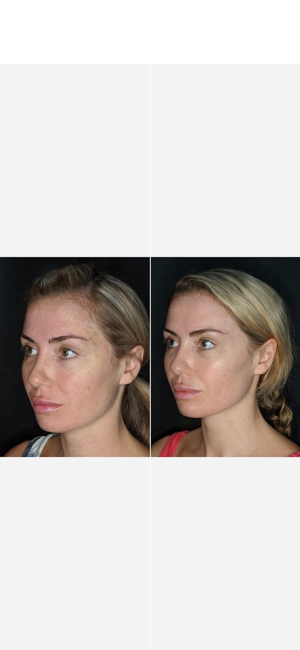 Laser Resurfacing Before & After Gallery - Patient 259325 - Image 3