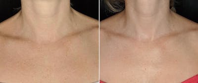 Laser Resurfacing Before & After Gallery - Patient 259325 - Image 4