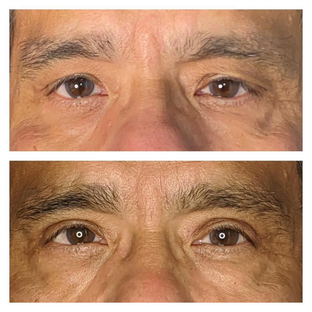 Upper Blepharoplasty Before & After Gallery - Patient 8561194 - Image 1