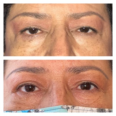 Upper Blepharoplasty Before & After Gallery - Patient 8561195 - Image 1
