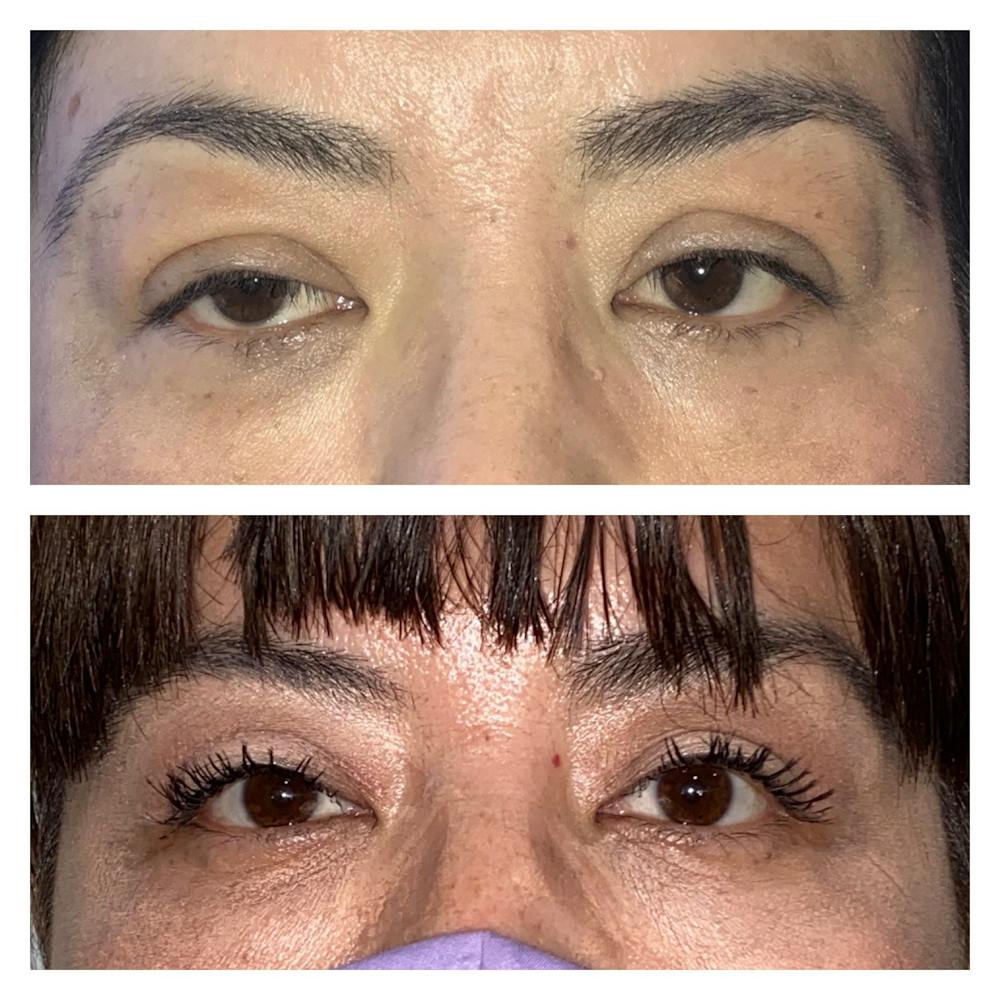 Ptosis Before & After Gallery - Patient 8561197 - Image 1
