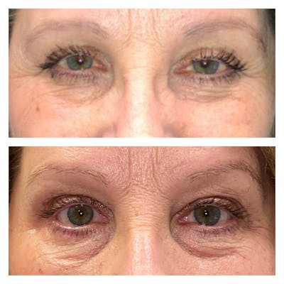 Ptosis Before & After Gallery - Patient 8561198 - Image 1