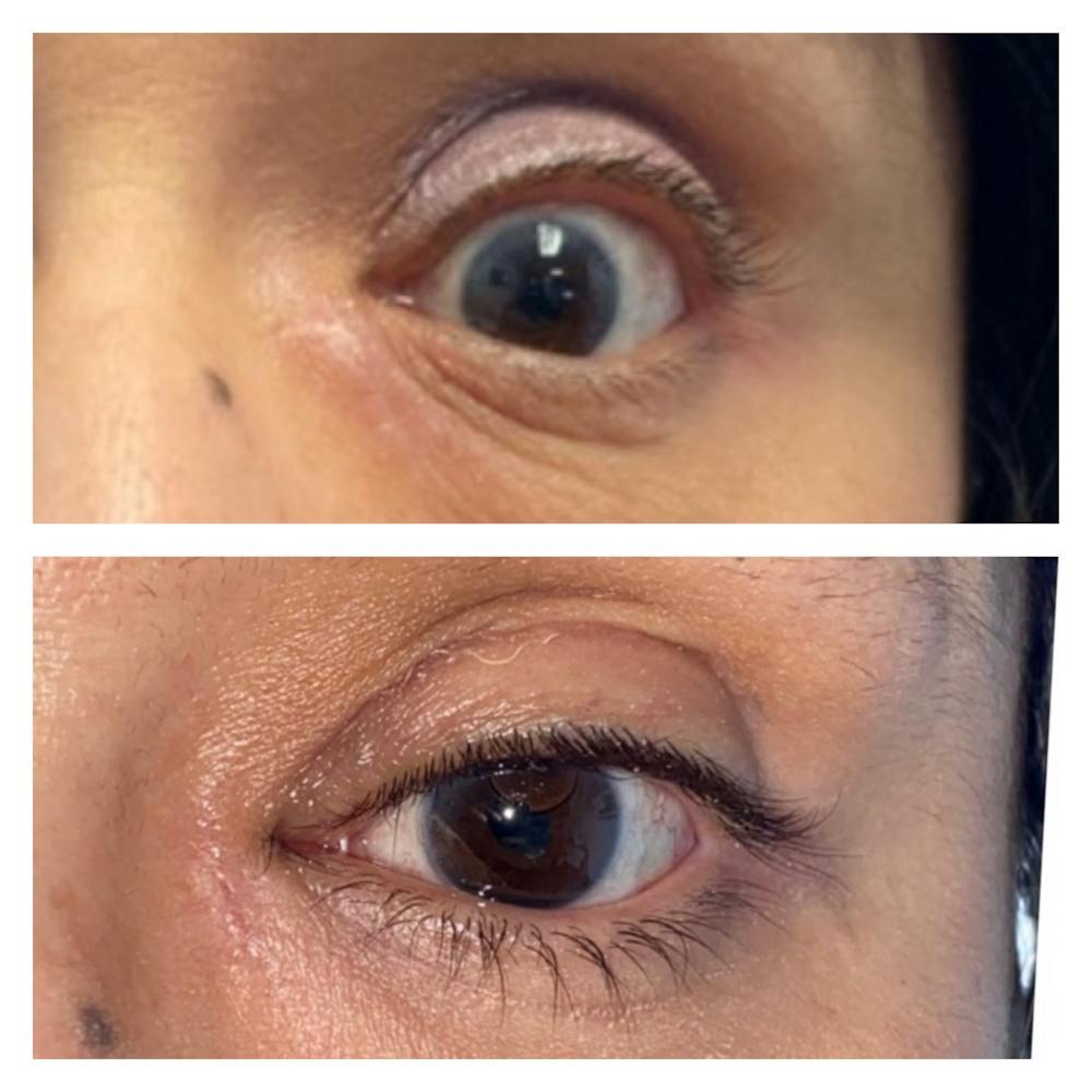 Eyelid Retraction Repair Before & After Gallery - Patient 8561212 - Image 1