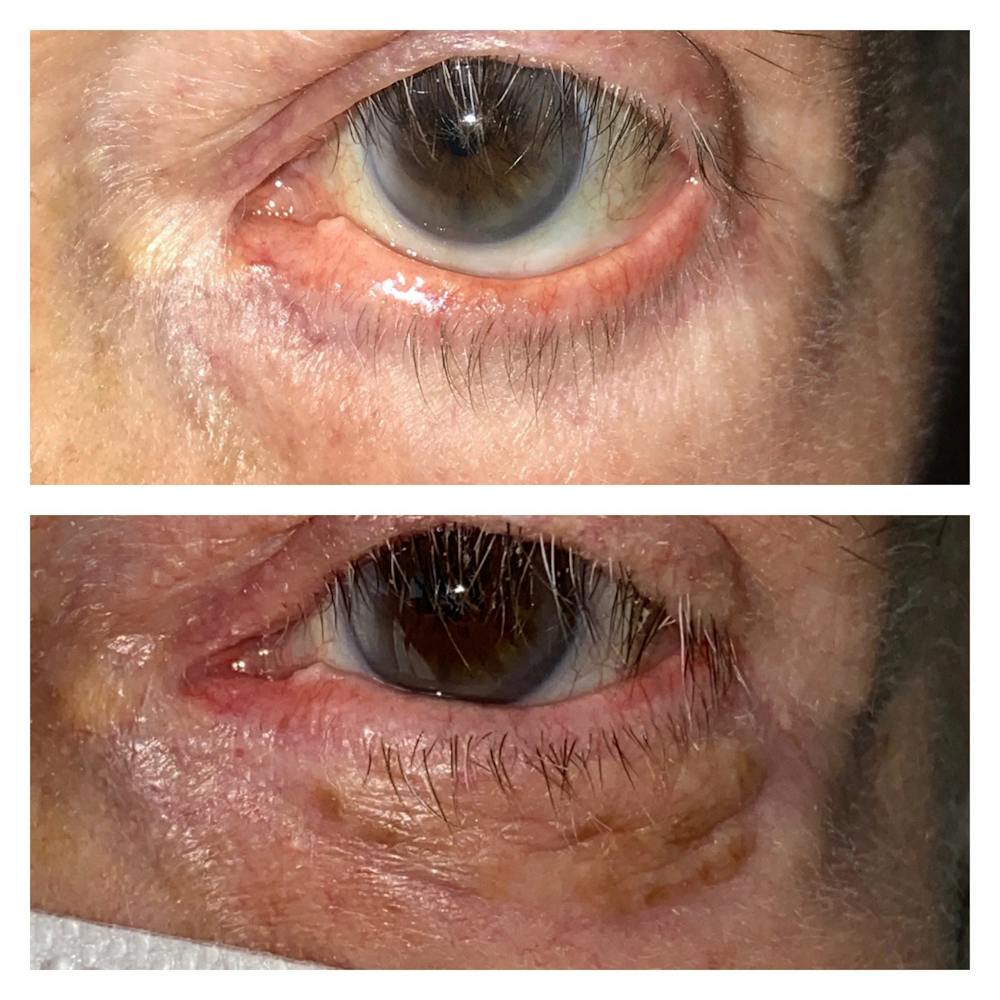 Eyelid Retraction Repair Before & After Gallery - Patient 8561273 - Image 1
