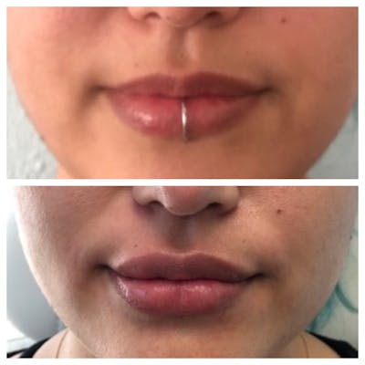 Lip Fillers Before & After Gallery - Patient 8561278 - Image 1
