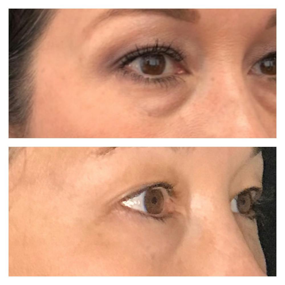 Accutite Before & After Gallery - Patient 8561280 - Image 2