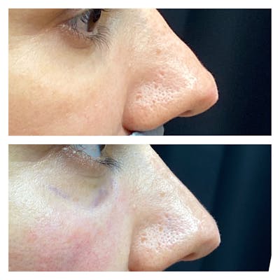 Dermal Fillers Before & After Gallery - Patient 56163407 - Image 1
