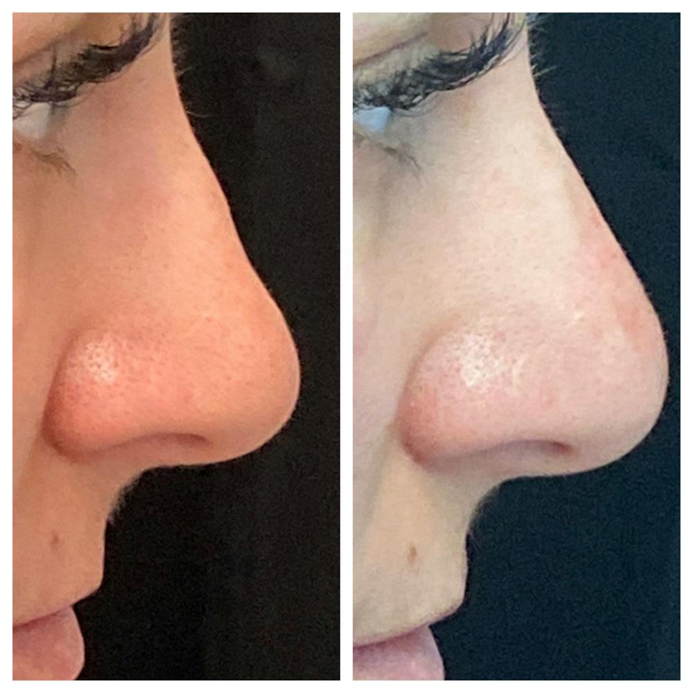 Dermal Fillers Before & After Gallery - Patient 56163473 - Image 1