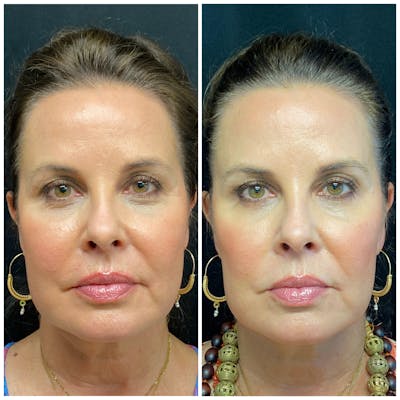 Evoke Radiofrequency Before & After Gallery - Patient 8693710 - Image 1