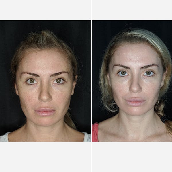 Laser Resurfacing Before & After Gallery - Patient 259325 - Image 1