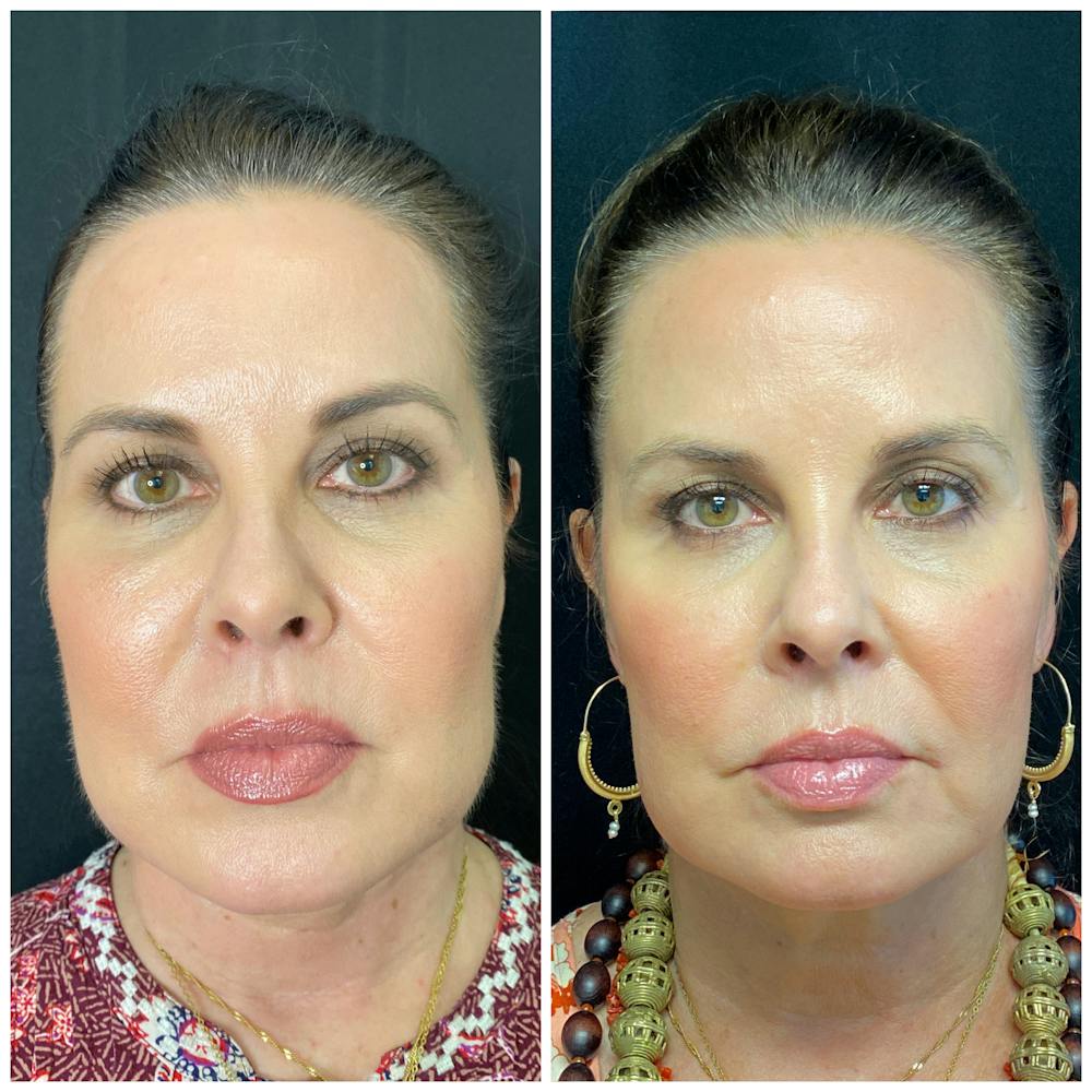 Non-Surgical Jawline Contouring Austin and Westlake