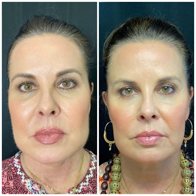 Lip Fillers Before & After Gallery - Patient 8693767 - Image 1