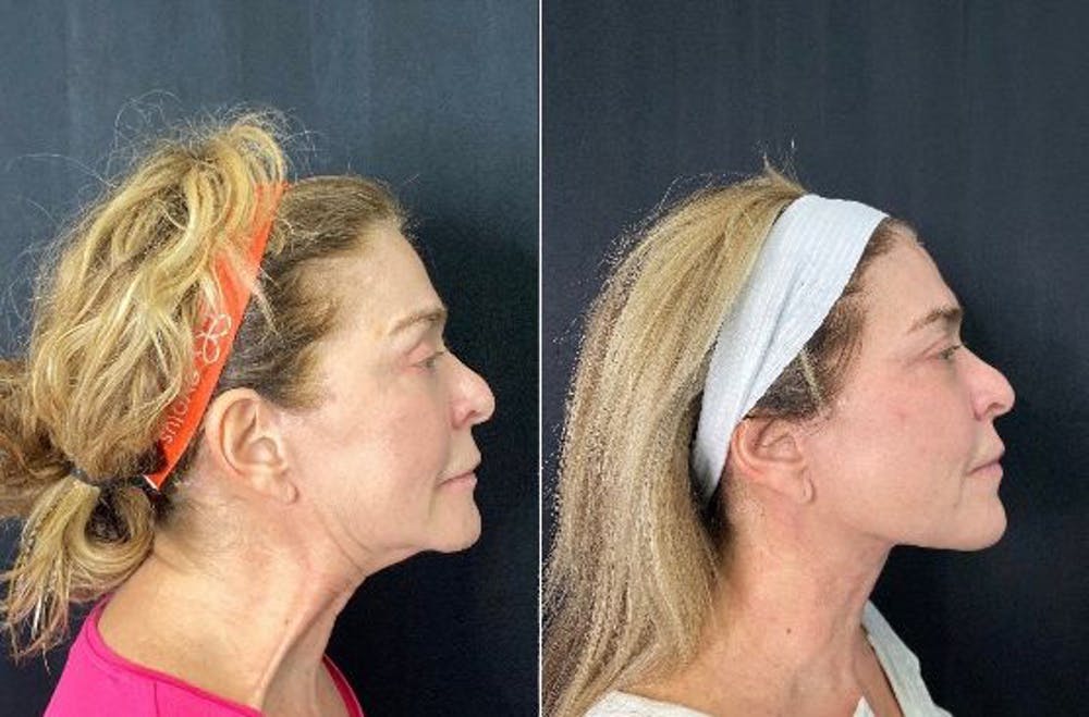 Facetite Before & After Gallery - Patient 8524382 - Image 1