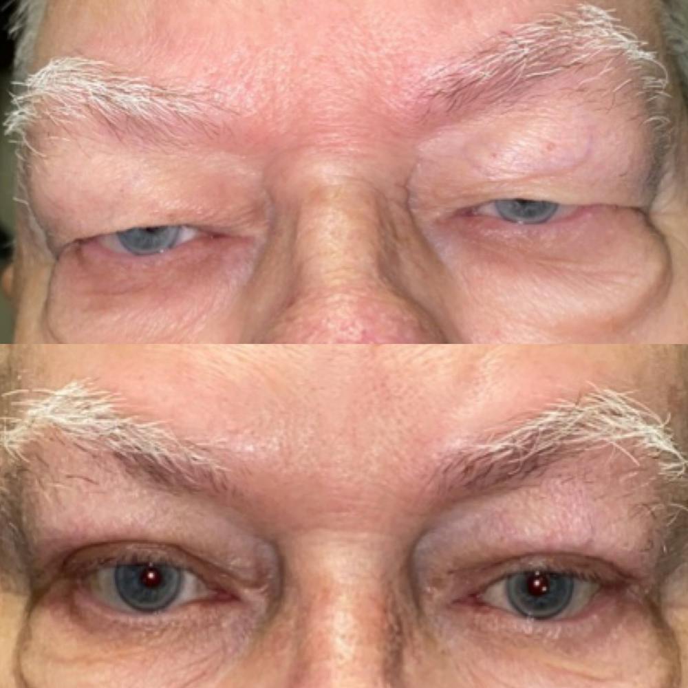 Upper Blepharoplasty Before & After Gallery - Patient 8693779 - Image 1