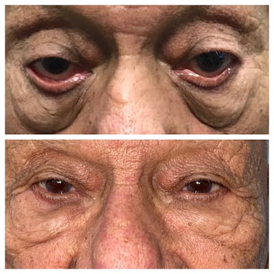 Ectropion Before & After Gallery - Patient 8693784 - Image 1