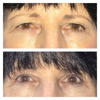 Ptosis Before & After Gallery - Patient 8693822 - Image 1