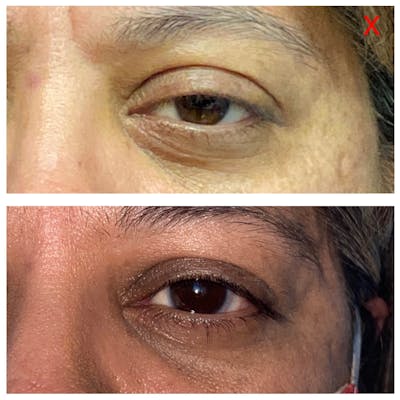 Ptosis Before & After Gallery - Patient 8693823 - Image 1