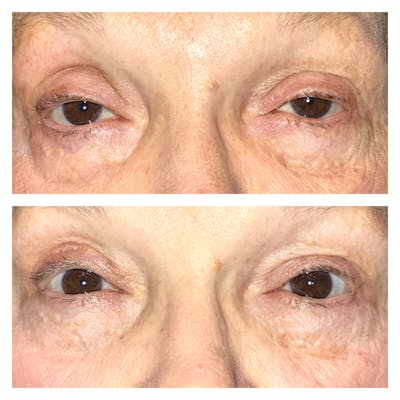 Ptosis Before & After Gallery - Patient 8693824 - Image 1