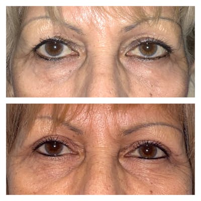 Ptosis Before & After Gallery - Patient 8693825 - Image 1
