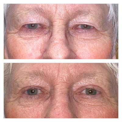 Upper Blepharoplasty Before & After Gallery - Patient 8693827 - Image 1