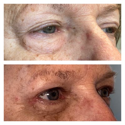 Lower Blepharoplasty Before & After Gallery - Patient 8693832 - Image 2