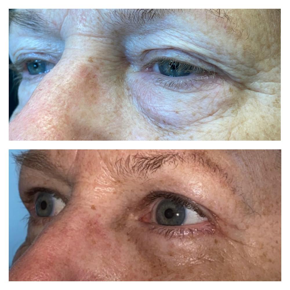 Lower Blepharoplasty Before & After Gallery - Patient 8693832 - Image 3