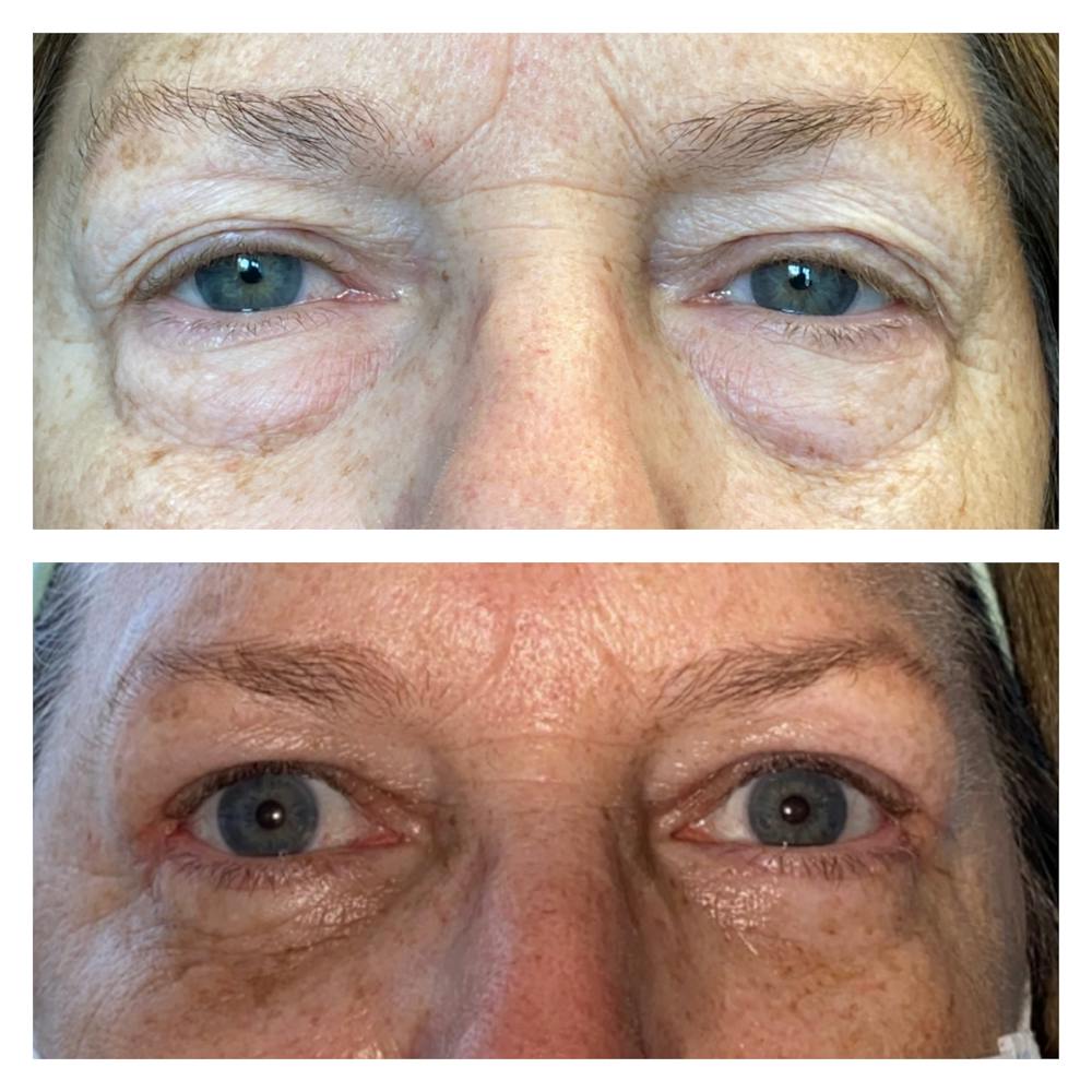 Lower Blepharoplasty Before & After Gallery - Patient 8693832 - Image 1