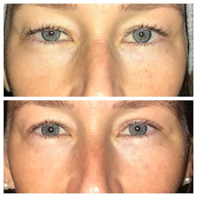 Ptosis Before & After Gallery - Patient 8693846 - Image 1