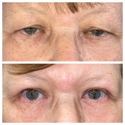 Ptosis Before & After Gallery - Patient 8693848 - Image 1
