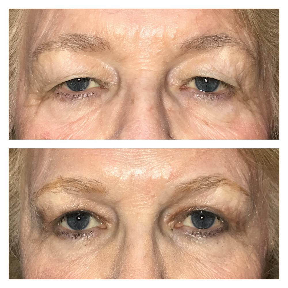 Ptosis Before & After Gallery - Patient 8693849 - Image 1