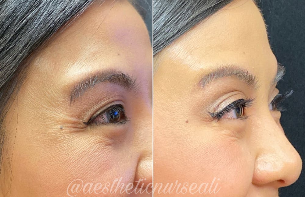 BOTOX Before & After Gallery - Patient 8525150 - Image 1