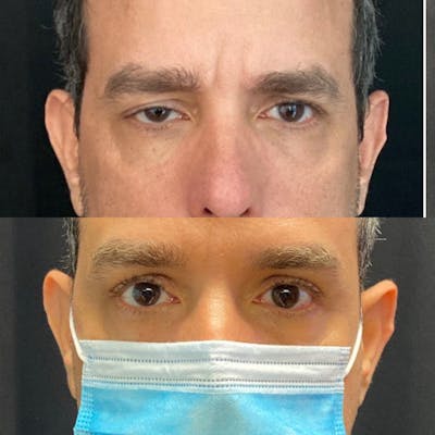 Ptosis Before & After Gallery - Patient 9494115 - Image 1
