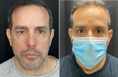 Ptosis Before & After Gallery - Patient 9494115 - Image 2