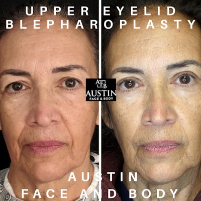 Upper Blepharoplasty Before & After Gallery - Patient 9494143 - Image 1