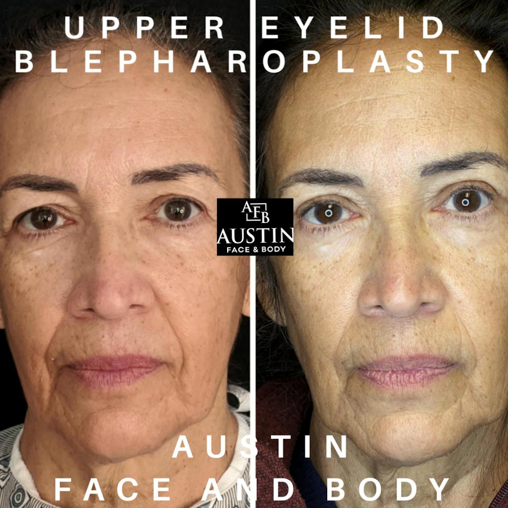 Upper Blepharoplasty Before & After Gallery - Patient 9494143 - Image 1